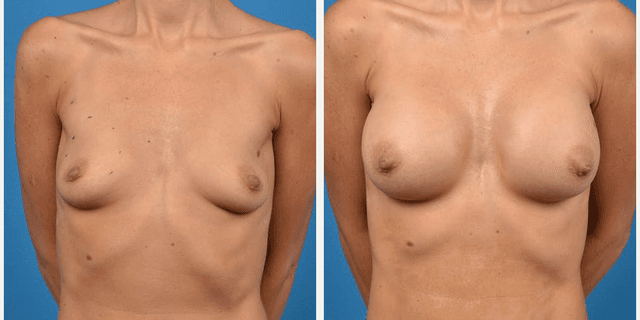 Breast Augmentation procedure image