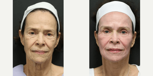 Facelift procedure image