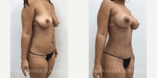 Breast Augmentation procedure image