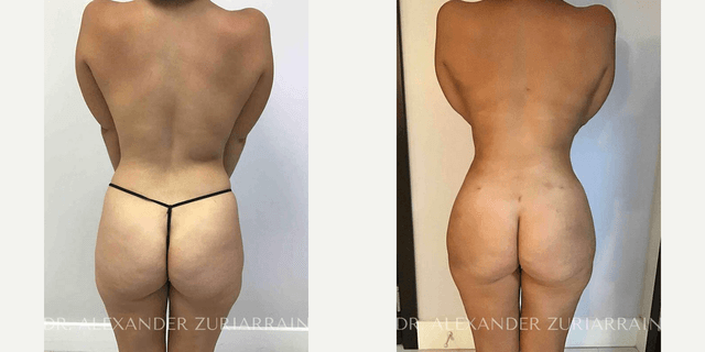 Brazilian Butt Lift (BBL) procedure image