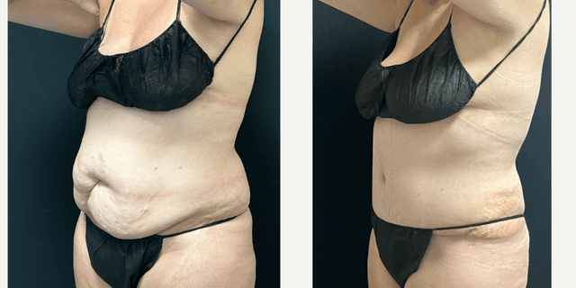 Tummy Tuck (Abdominoplasty) procedure image
