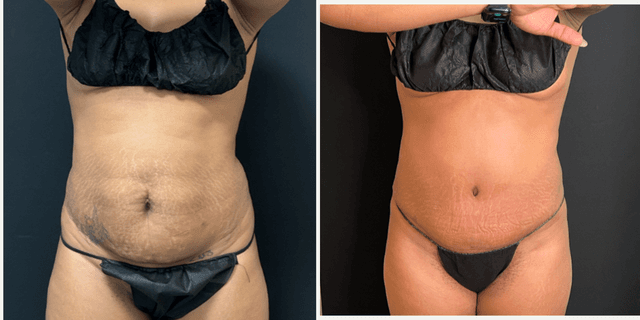 Mommy Makeover procedure image