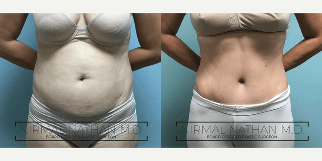 Mommy Makeover procedure image
