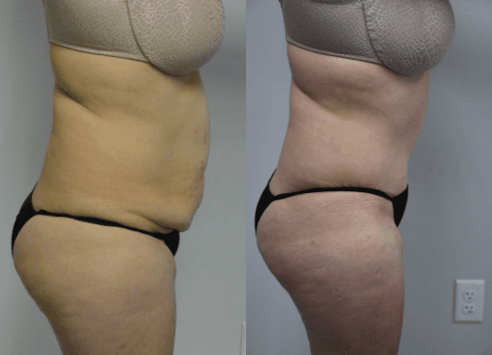 Mommy Makeover procedure image