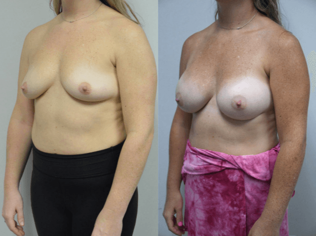 Breast Augmentation procedure image