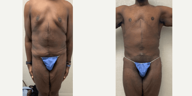 Skin Tightening procedure image