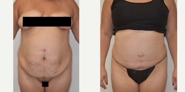 Mommy Makeover procedure image