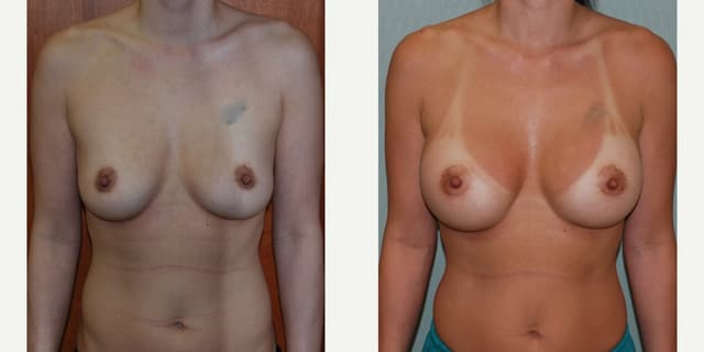 Breast Augmentation procedure image