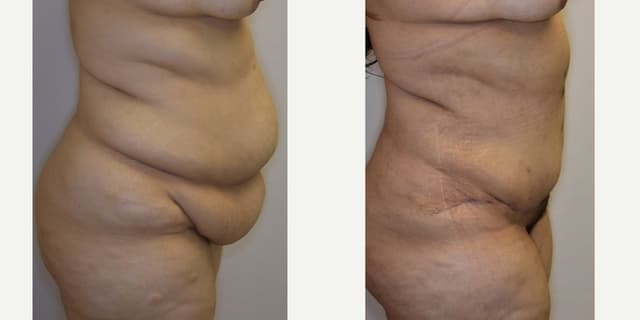 Tummy Tuck (Abdominoplasty) procedure image