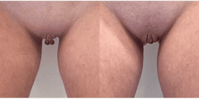 Vaginal Rejuvenation procedure image