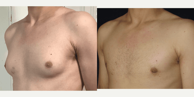 Body Lift procedure image