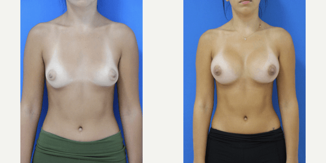 Breast Augmentation procedure image