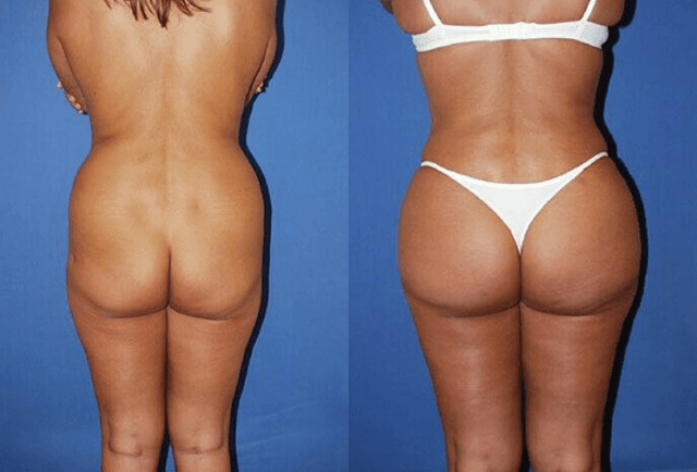 Butt Implants procedure image