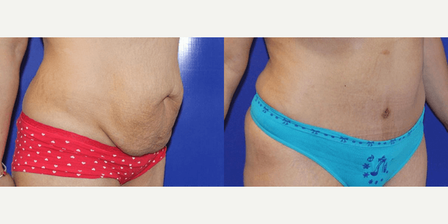Skin Tightening procedure image