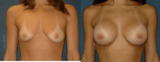 Breast Augmentation procedure image