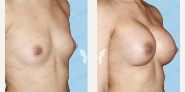 Mommy Makeover procedure image