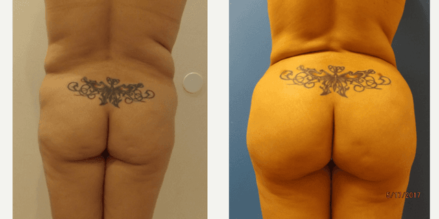 Hip Enhancement procedure image