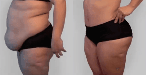 Body Lift procedure image