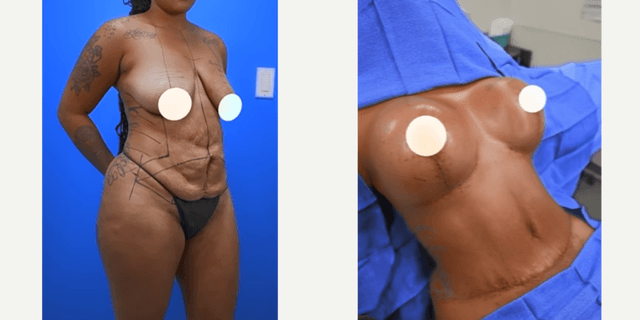 Skin Tightening procedure image