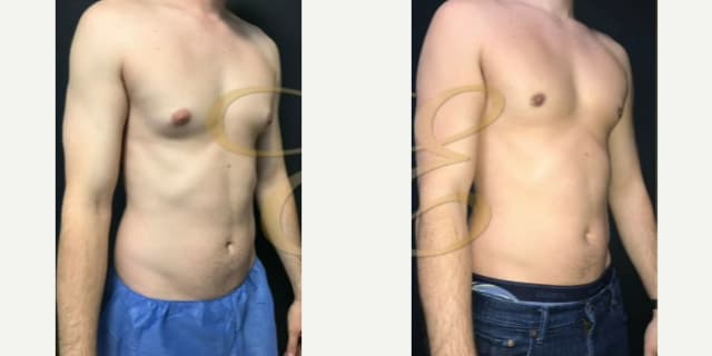 Mommy Makeover procedure image