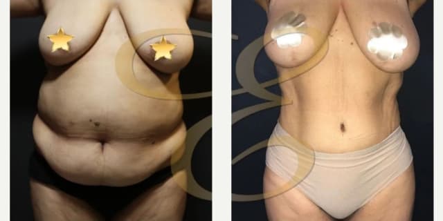 Body Lift procedure image