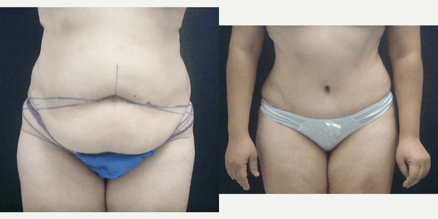 Tummy Tuck (Abdominoplasty) procedure image