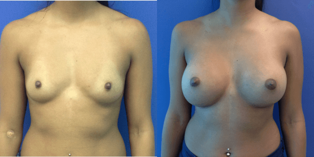 Breast Augmentation procedure image