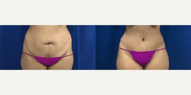 Mommy Makeover procedure image