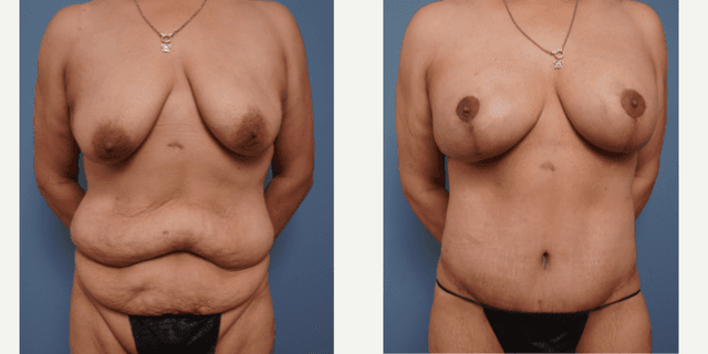 Skin Tightening procedure image