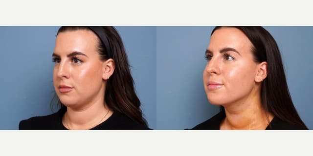 Facelift procedure image