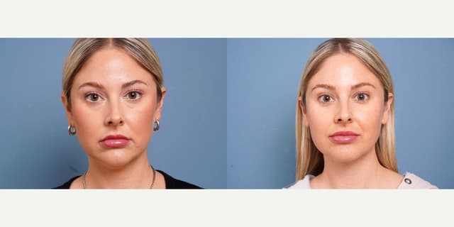 Rhinoplasty (Nose Job) procedure image