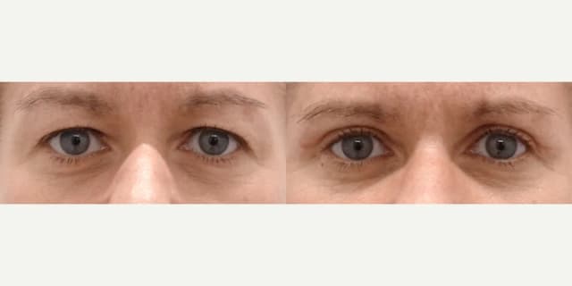 Eyelid Surgery (Blepharoplasty) procedure image