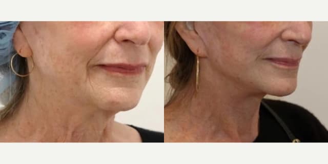 Facelift procedure image
