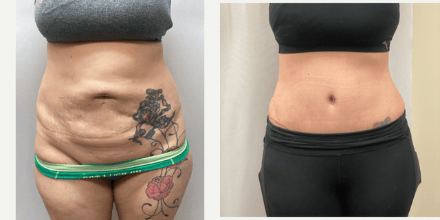 Skin Tightening procedure image