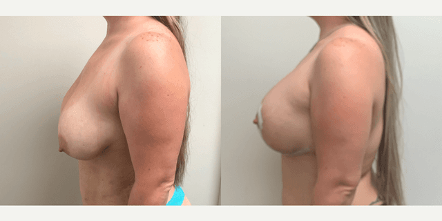 Breast Augmentation procedure image