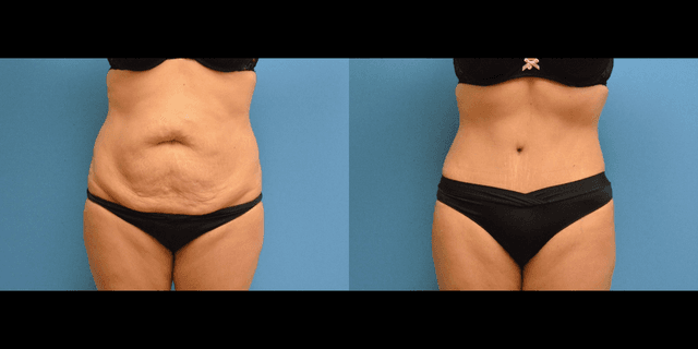 Tummy Tuck (Abdominoplasty) procedure image