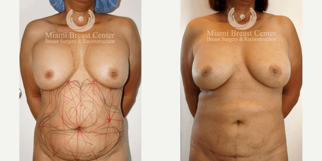 Breast Augmentation procedure image