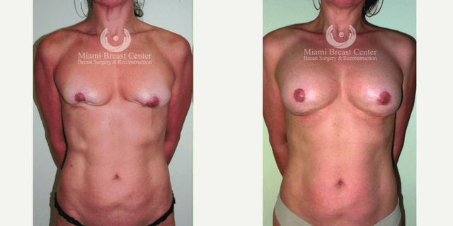 Breast Lift (Mastopexy) procedure image
