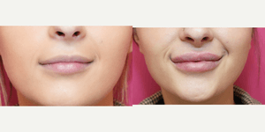 Lip Enhancement (Fillers) procedure image