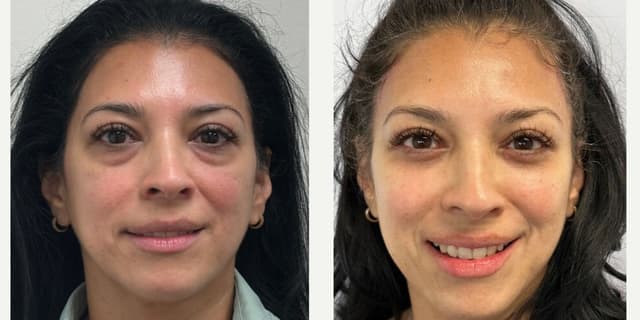 Fillers & Injectables (e.g. Botox, Juvederm) procedure image