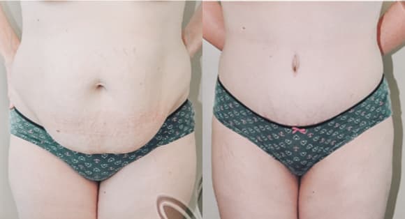 Mommy Makeover procedure image