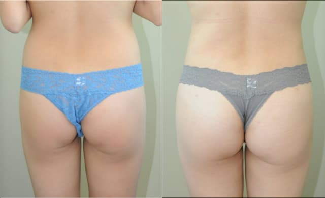 Brazilian Butt Lift (BBL) procedure image