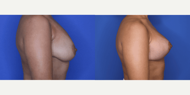 Mommy Makeover procedure image