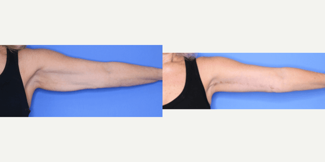 Skin Tightening procedure image