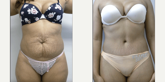 Mommy Makeover procedure image