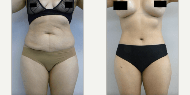 Tummy Tuck (Abdominoplasty) procedure image