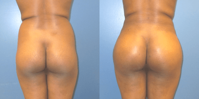 Hip Enhancement procedure image