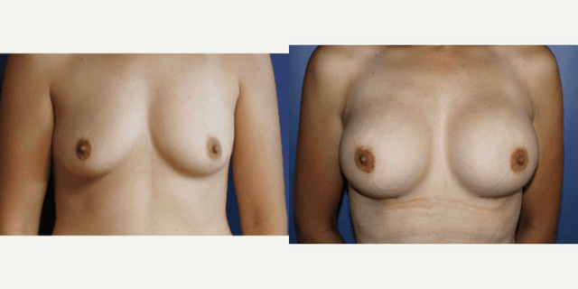 Mommy Makeover procedure image