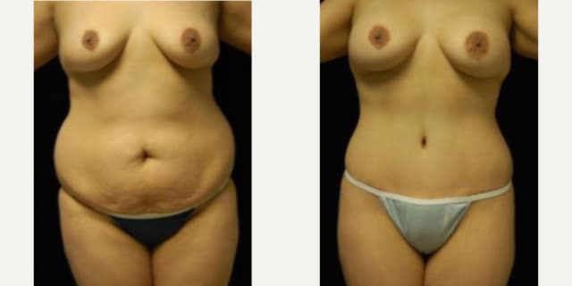 Tummy Tuck (Abdominoplasty) procedure image