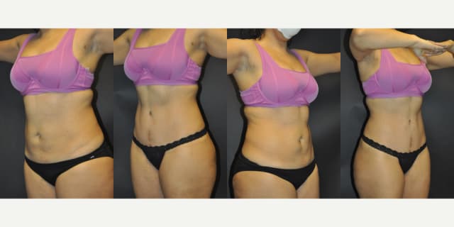 Mommy Makeover procedure image